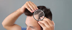 Does Dandruff Cause Hair Fall?